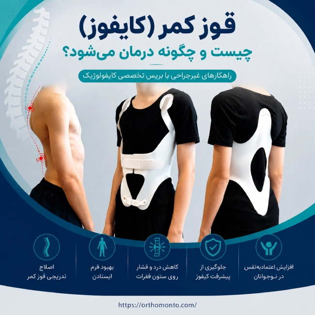 درمان کایفوز